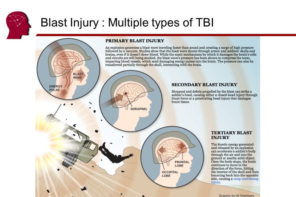 Understanding TBI Waiver Programs